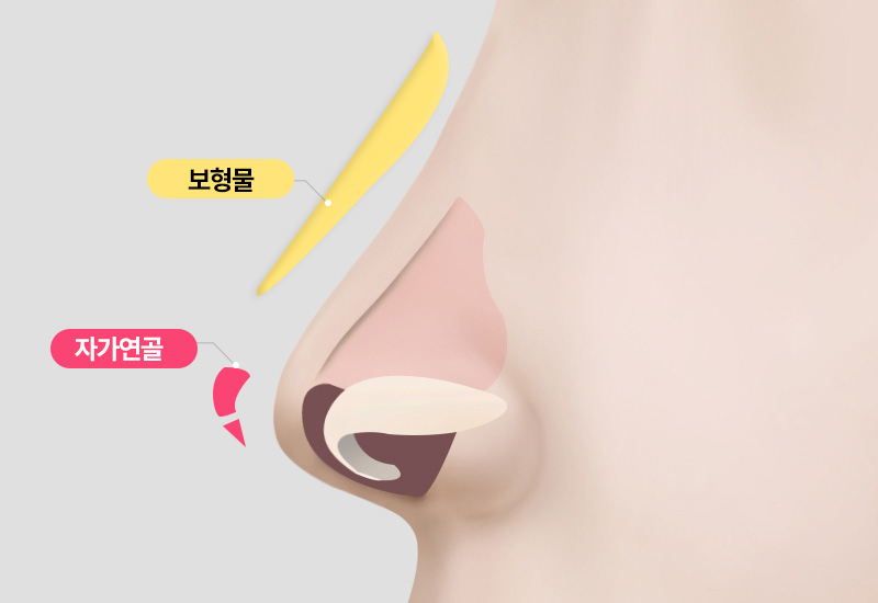보형물 삽입