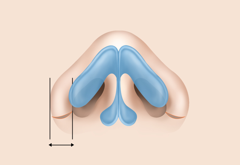 외측절개