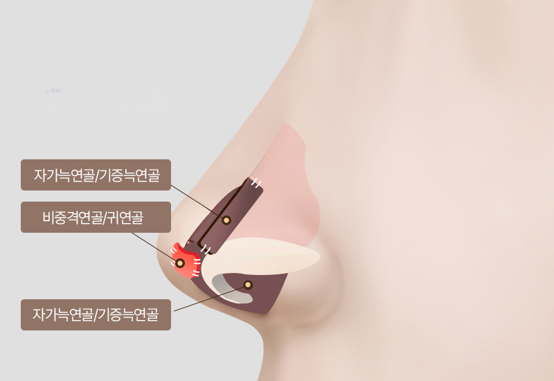 자가연골 활용