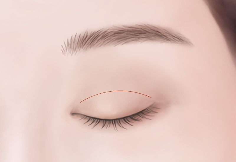 수술 디자인