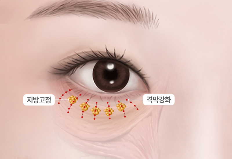 봉합 및 회복